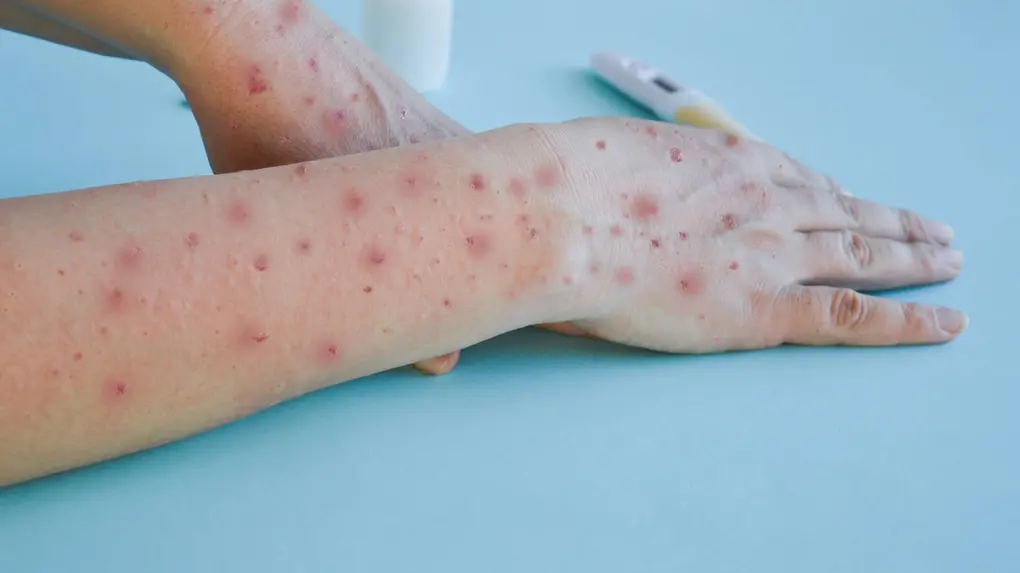 Ceará registra primeiro caso de mpox em 2026 no estado